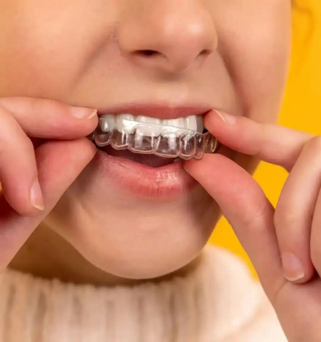 Clear Aligners at Hutt Dental Hub