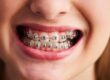 Braces