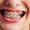 Braces