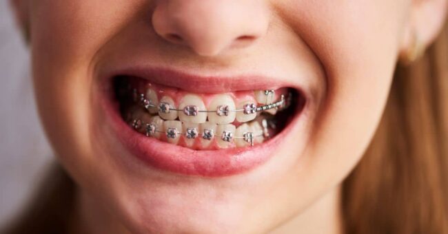 Braces
