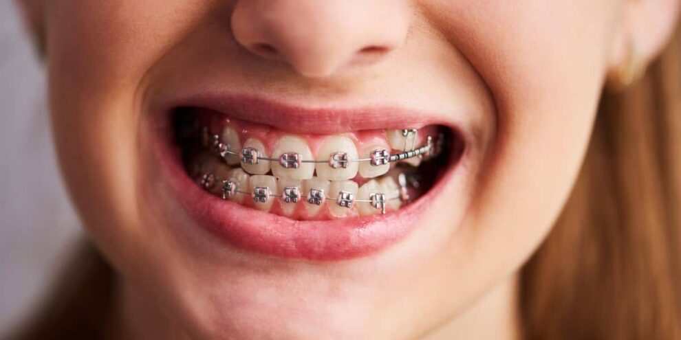 Braces