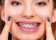 Braces