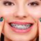Braces
