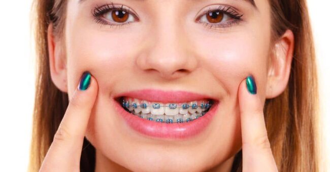 Braces