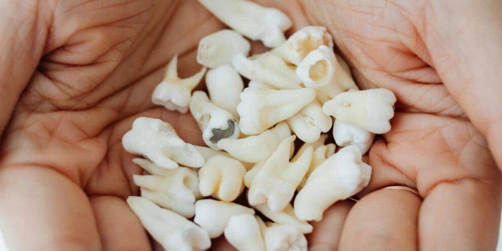 Wisdom Tooth Removal