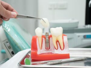 single dental implant