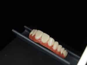 Full Mouth Dental Implants